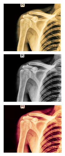 Rotator Cuff Repair